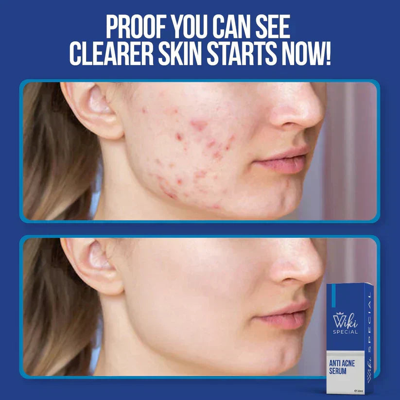 Wiki Special Anti Acne Serum
